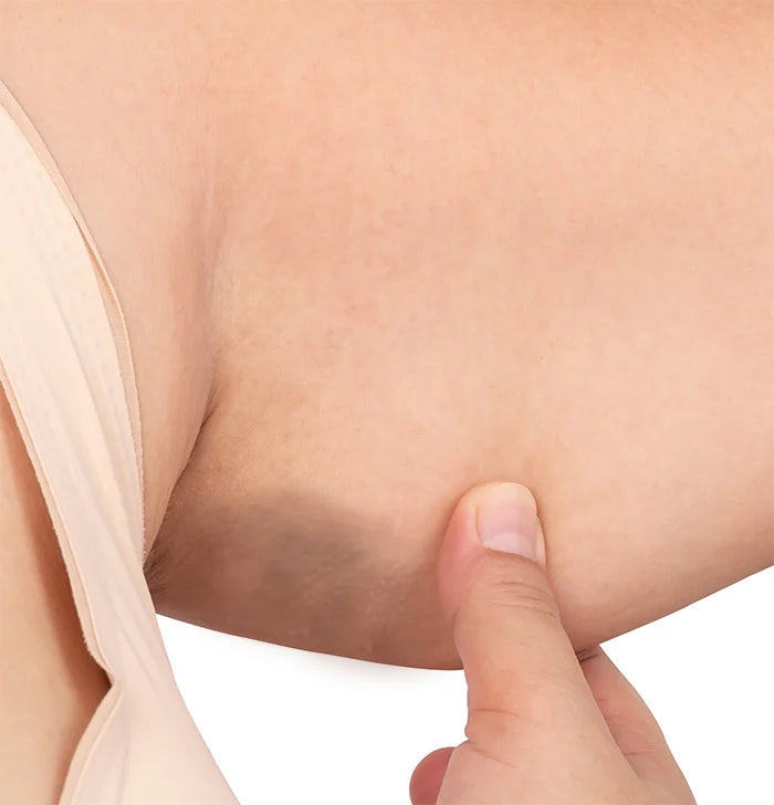 Acanthosis Nigricans (Skin Darkening)